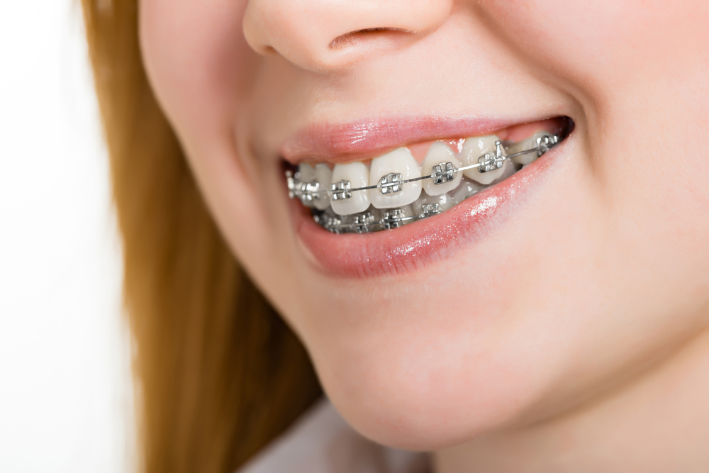 Braces and Dental Implants