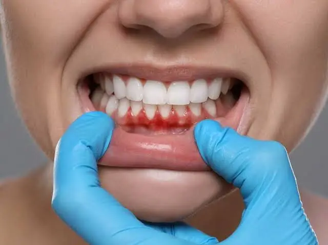 Periodontal Disease Treatment