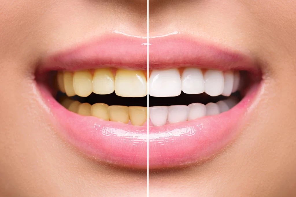 Professional Teeth Whitening